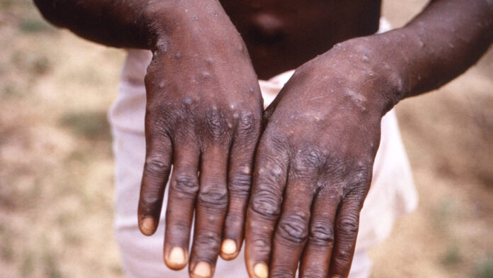 Monkeypox Cases Detected in 20 Countries, WHO Says